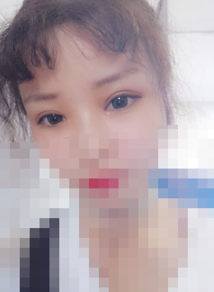 双眼皮修复的方法