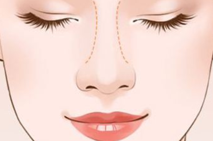 【隆鼻科普】你想知道的隆鼻问题都在这里哦!