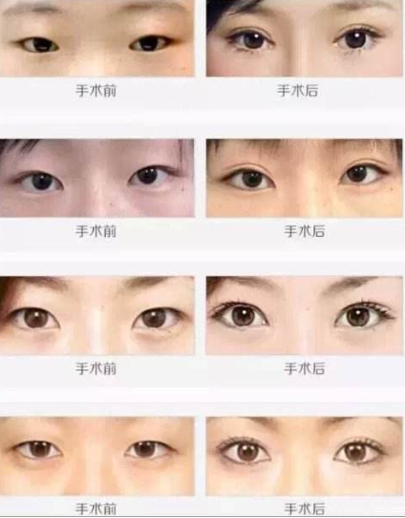 广州地区双眼皮做的好的医生测评之一