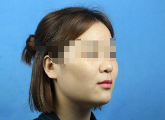 成都贾德渊隆鼻怎么样?隆鼻案例分享