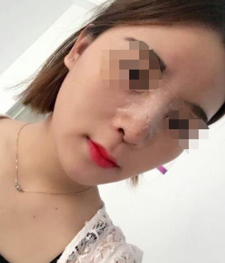 成都贾德渊隆鼻怎么样?隆鼻案例分享