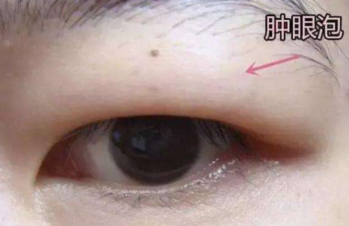科普:你的眼睛适合做哪种双眼皮手术?