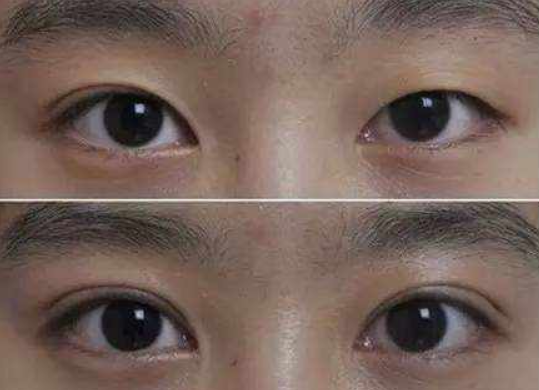 眼睛一单一双,双眼皮可以做一只吗?