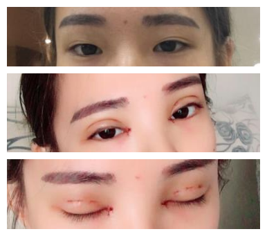 在长沙美之峰找解灿做双眼皮一年零八个月了