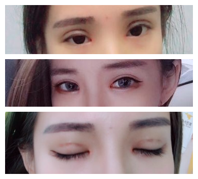 在长沙美之峰找解灿做双眼皮一年零八个月了