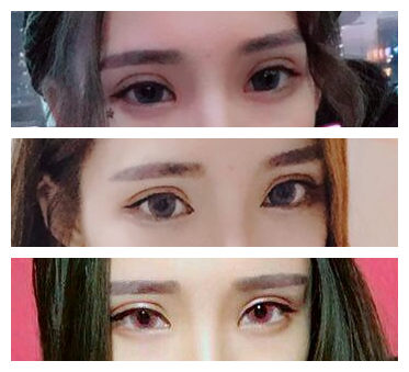 在长沙美之峰找解灿做双眼皮一年零八个月了