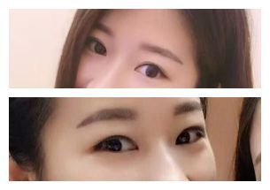 术后69天分享,拯救内双肿泡眼
