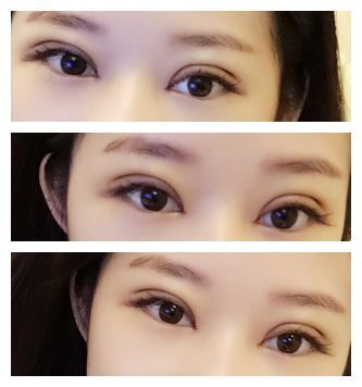 术后69天分享,拯救内双肿泡眼