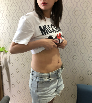 在天津做腰腹吸脂的第3天,肚子还是有点大