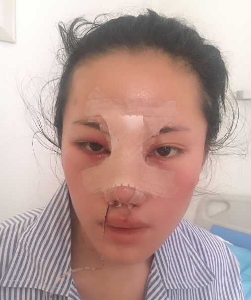 在昆明梦想做的隆鼻,一个多月了