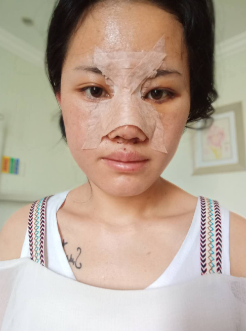 在昆明梦想做的隆鼻,一个多月了