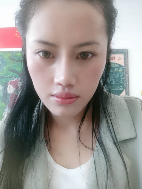 在昆明梦想做的隆鼻,一个多月了