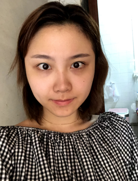 在广州广美找孙恺做的双眼皮,恢复120天了