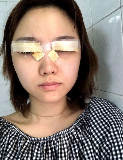 在广州广美找孙恺做的双眼皮,恢复120天了
