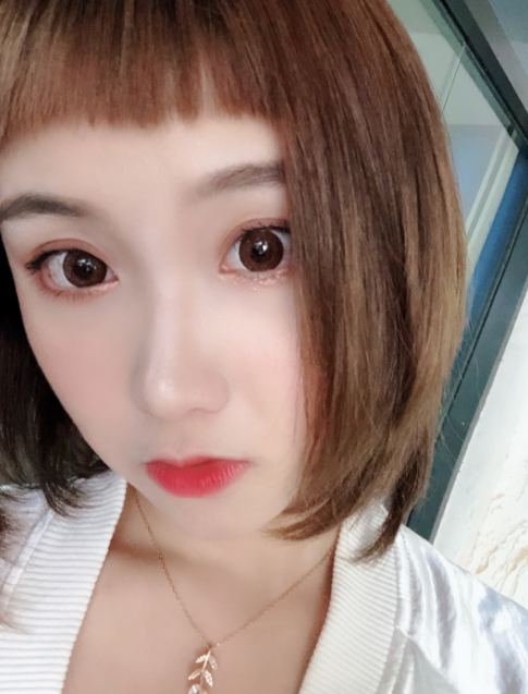 在广州广美找孙恺做的双眼皮,恢复120天了