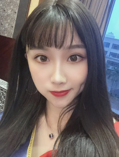 在广州广美找孙恺做的双眼皮,恢复120天了