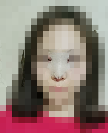 在福州爱美尔做的隆鼻,张胜利医生的做出来的