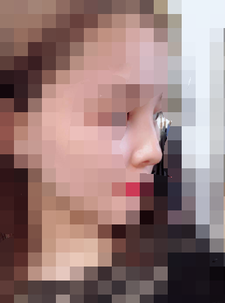 在福州爱美尔做的隆鼻,张胜利医生的做出来的