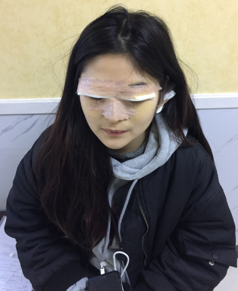 在成都军建做的双眼皮和隆鼻,太好看了