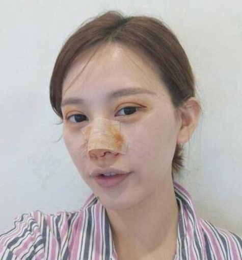 在南昌韩美做的隆鼻和双眼皮,快四个月了
