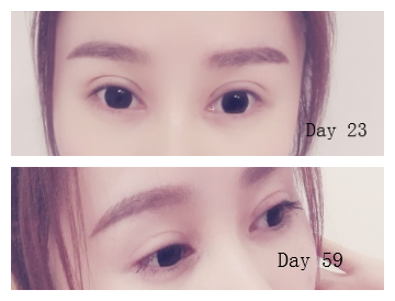 在长沙华韩华美做的双眼皮,已经183天了