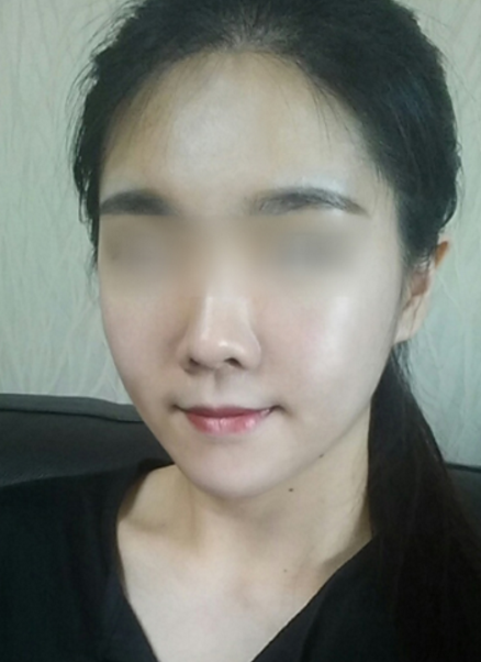 在广州紫馨做的超声波吸脂瘦脸,3个月了