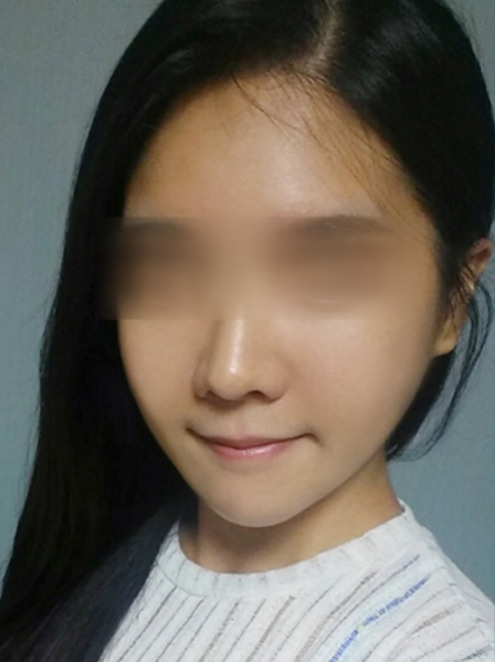 在广州紫馨做的超声波吸脂瘦脸,3个月了