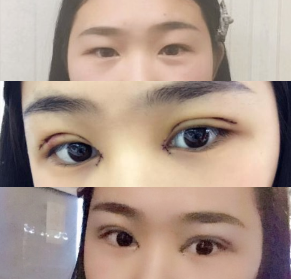 在石家庄雅芳亚做的双眼皮和开眼角,恢复的很