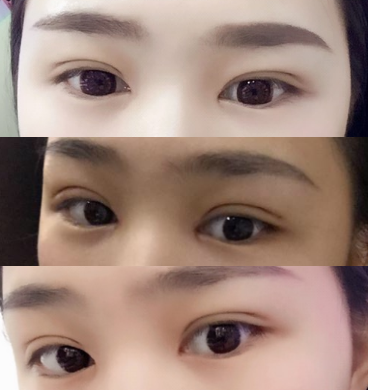 在石家庄雅芳亚做的双眼皮和开眼角,恢复的很