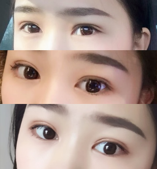 在石家庄雅芳亚做的双眼皮和开眼角,恢复的很