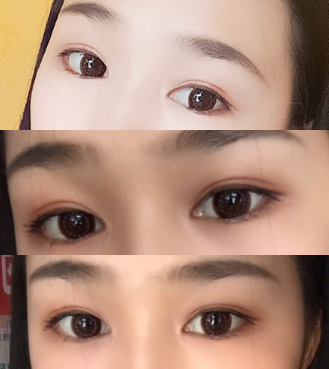 在石家庄雅芳亚做的双眼皮和开眼角,恢复的很