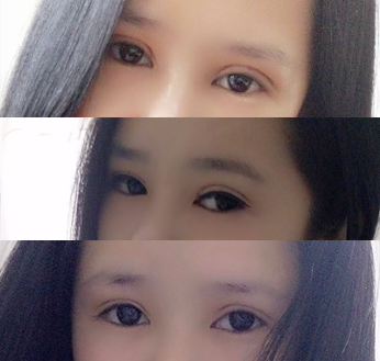 在成都艾米丽做的双眼皮,3个多月了